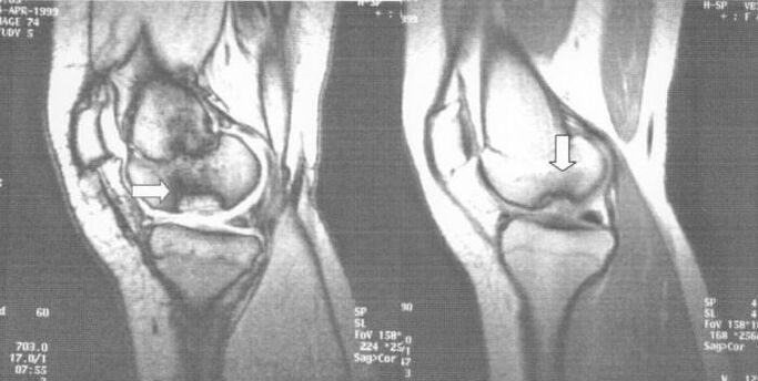 x-ray ของ osteochondrosis dissecans ในข้อเข่า